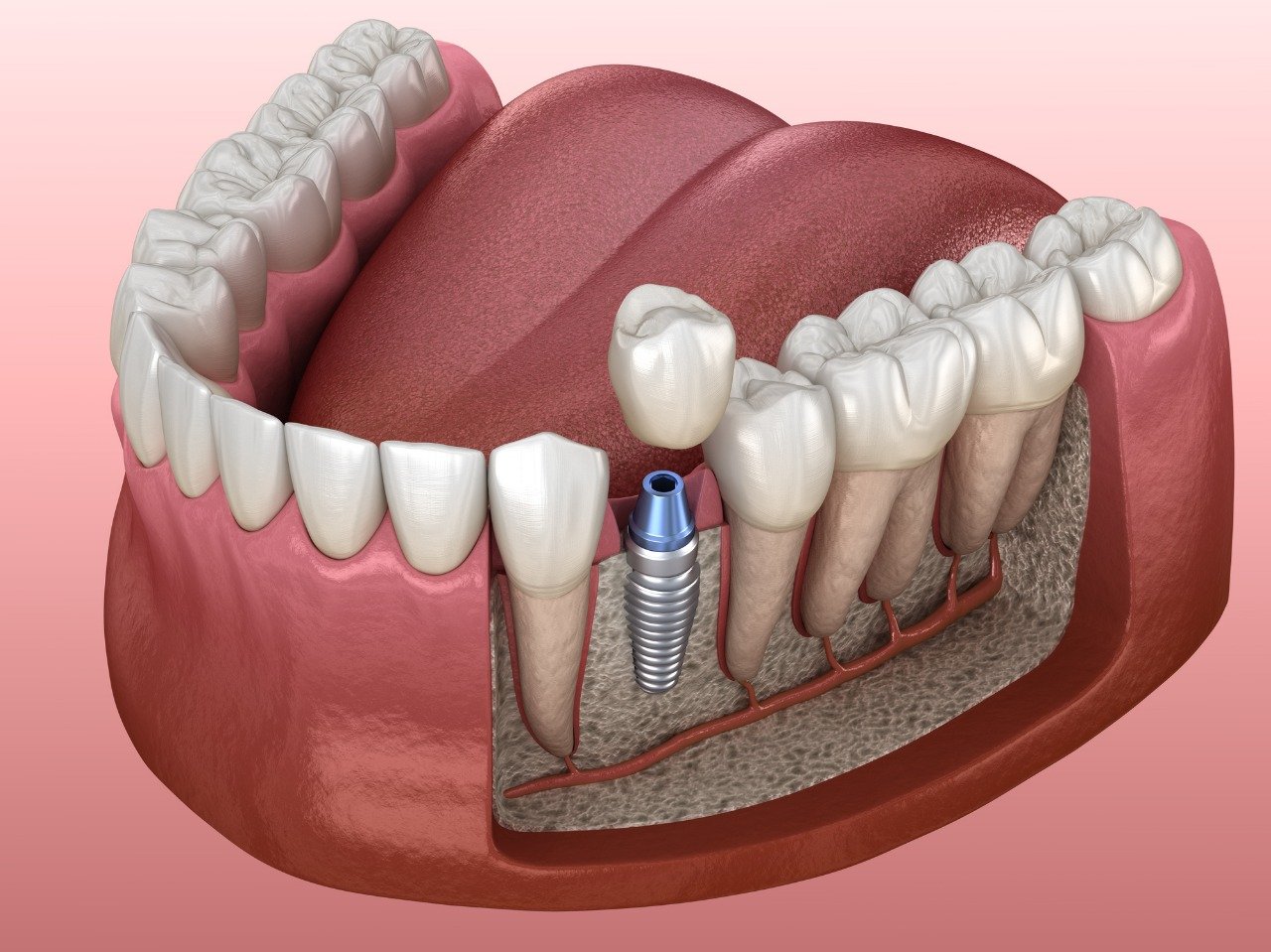 Dental Implant Rehabilitation