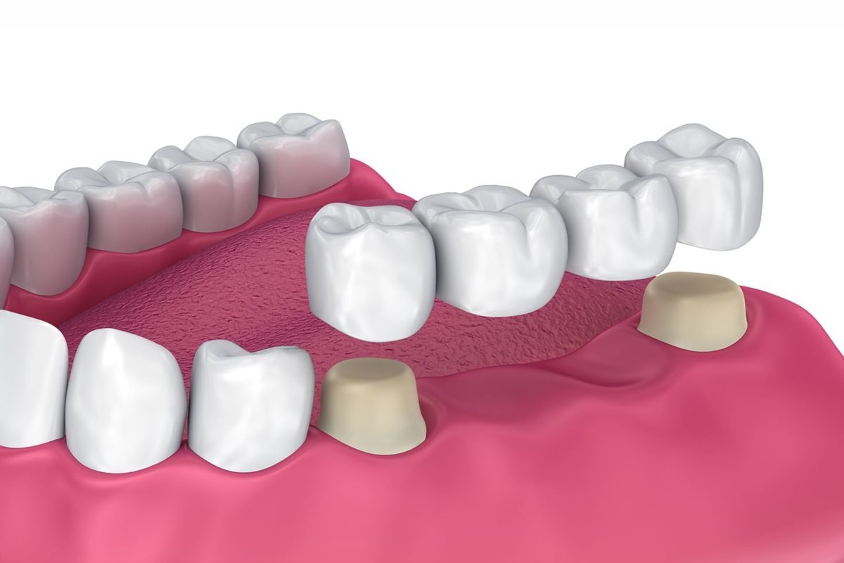 Prosthodontics (Crowns, Bridges & Dentures)
