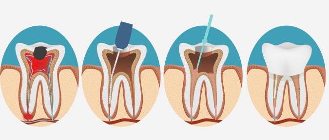 Root Canal Treatment (RCT)